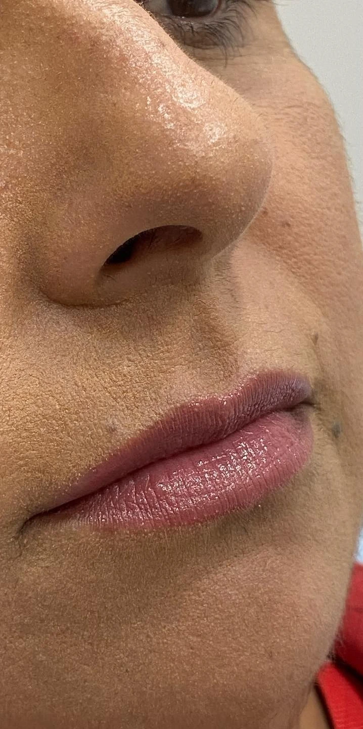 Dra. Aline Francini especialista em harmonização facial em Três Lagoas MS