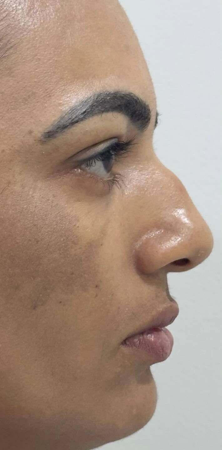 Dra. Aline Francini especialista em harmonização facial em Três Lagoas MS