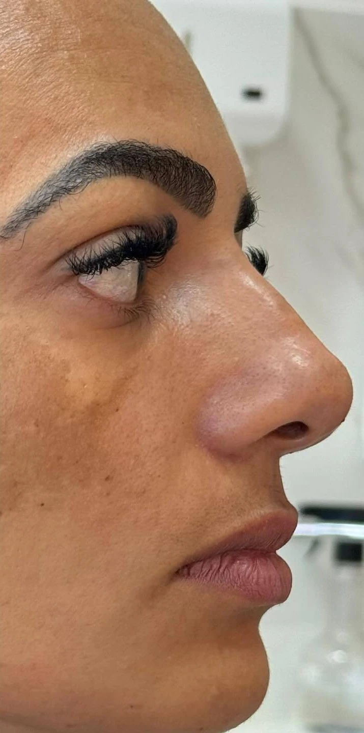 Dra. Aline Francini especialista em harmonização facial em Três Lagoas MS